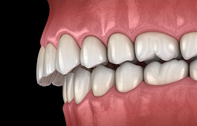 Illustration of an overbite