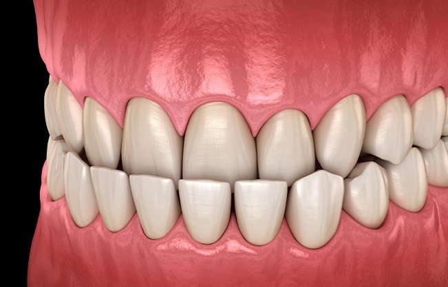 Illustration of an underbite