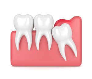 Illustration of an impacted wisdom tooth