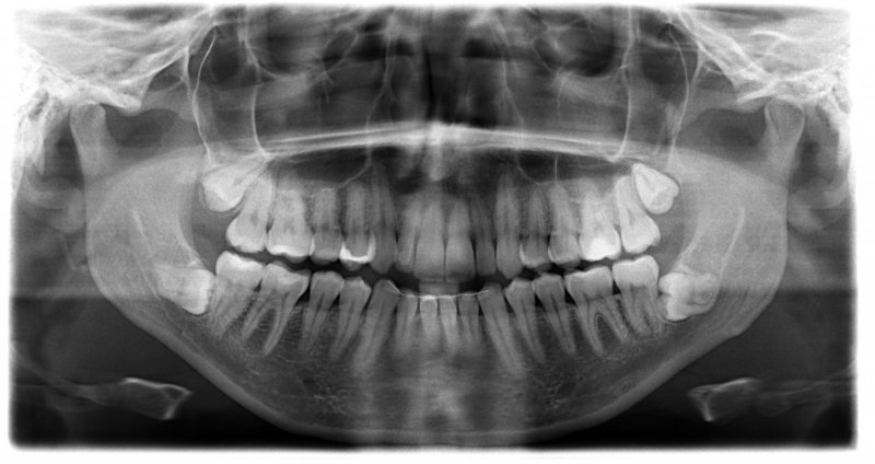 A dental X-ray of a patient with wisdom teeth