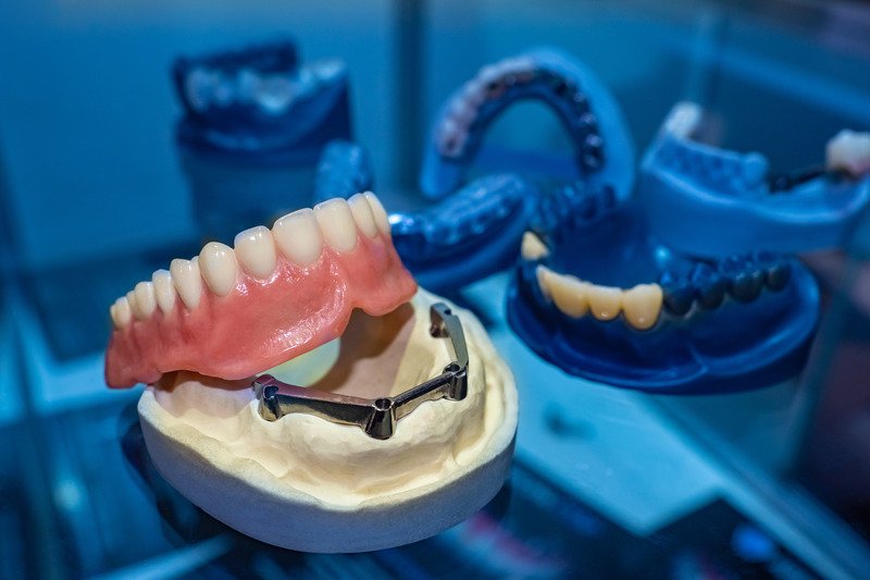 Example of dentures to be secured with dental implants