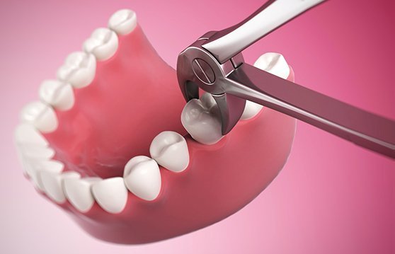 Tooth Extraction